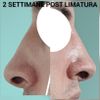 Limatura callo osseo post rinoplastica