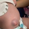 Ernia bambina 2 mesi