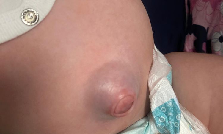 Ernia bambina 2 mesi - 78963