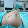 Mastopessi con protesi e seno deforme