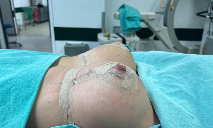 Mastopessi con protesi e seno deforme - 79158
