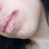 Cheilite angolare dopo intervento odontoiatrico