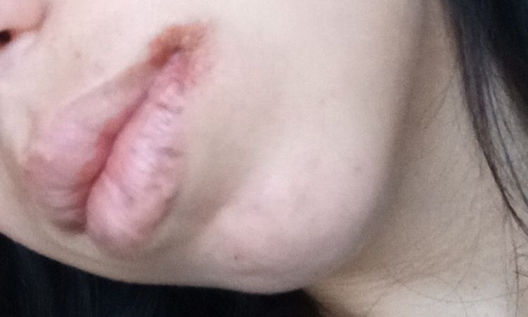 Cheilite angolare dopo intervento odontoiatrico - 79354