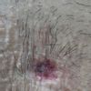 Effetti infiltrazioni kenacort per cheloide