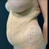 Liposcultura 360 addome
