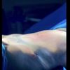 Liposcultura 360 addome