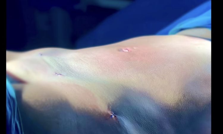 Liposcultura 360 addome - 79483