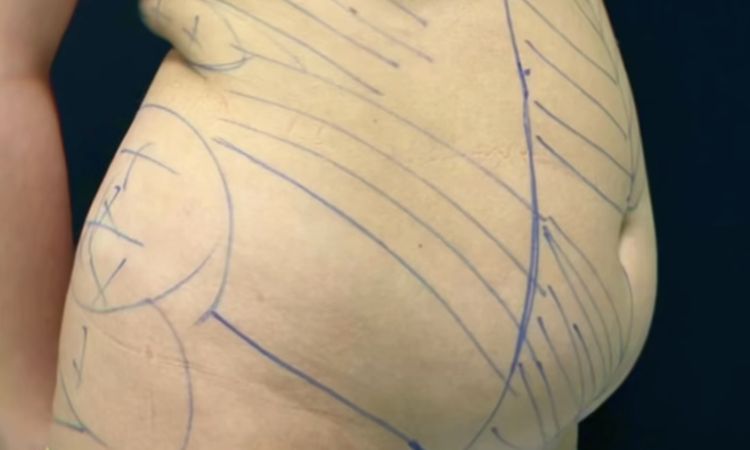 Liposcultura 360 addome - 79485