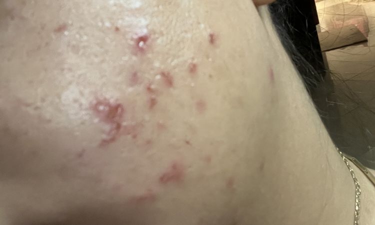Cicatrici post spremitura - 79565