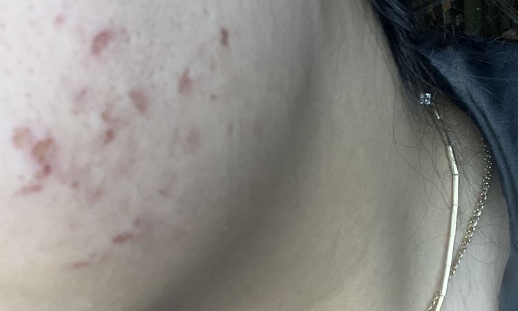 Cicatrici post spremitura - 79566