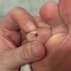 È un neo pericoloso?