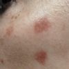 Macchie post laser co2