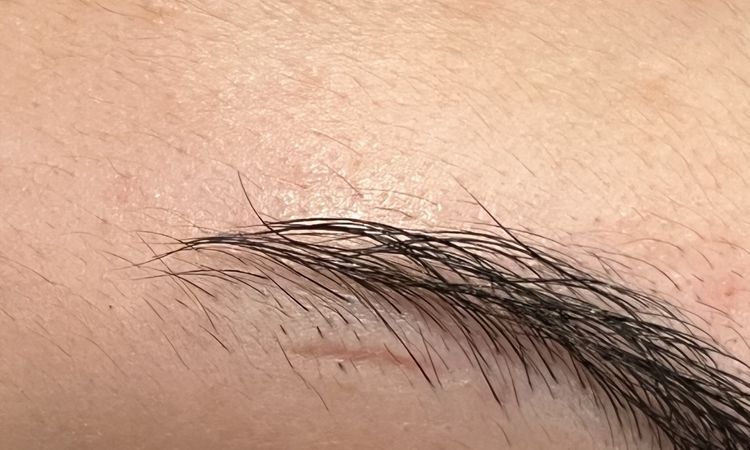 Tempi di guarigione taglio sopracciglio - 79946