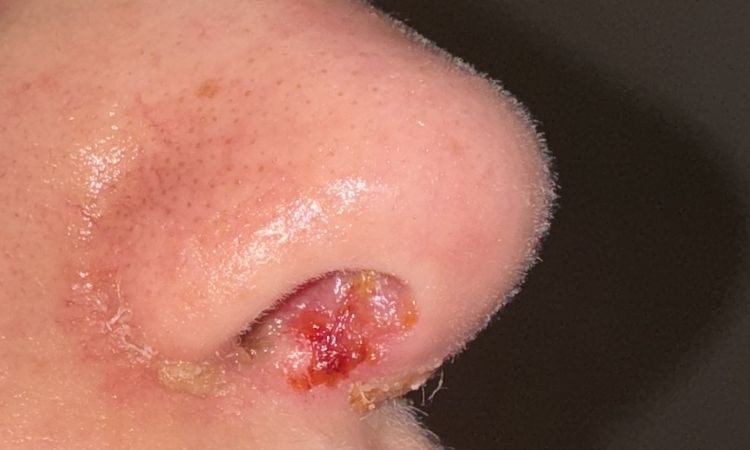 Infezione narici post rinoplastica - 80144
