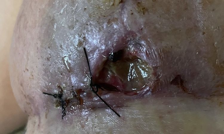 Deiscenza che peggiora? - 80482