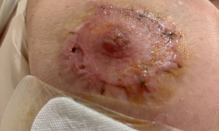 Infezione in seguito a cerchiaggio areole - 80483