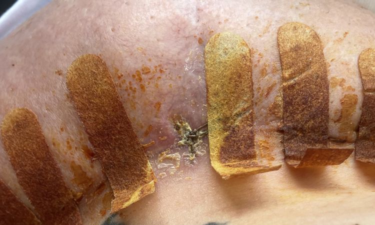 Mastoplastica riduttiva: punto con infezione? - 80655