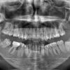 Quale trattamento migliore per malocclusione II classe e mento indietro?