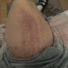 Ematomi strani dopo che mi gratto la gamba