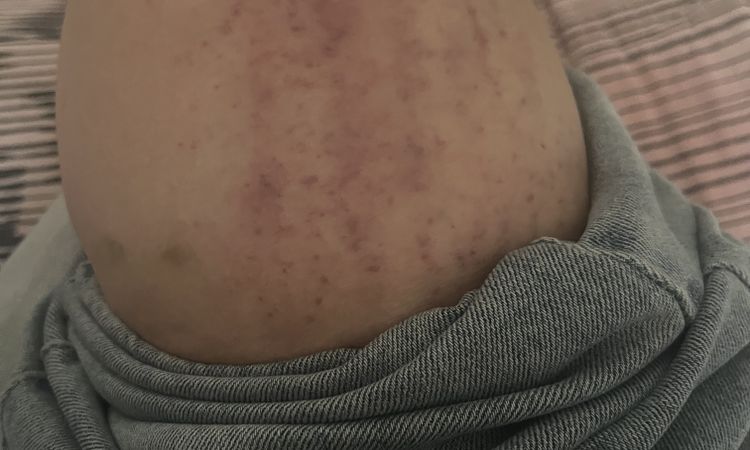 Ematomi strani dopo che mi gratto la gamba - 80705