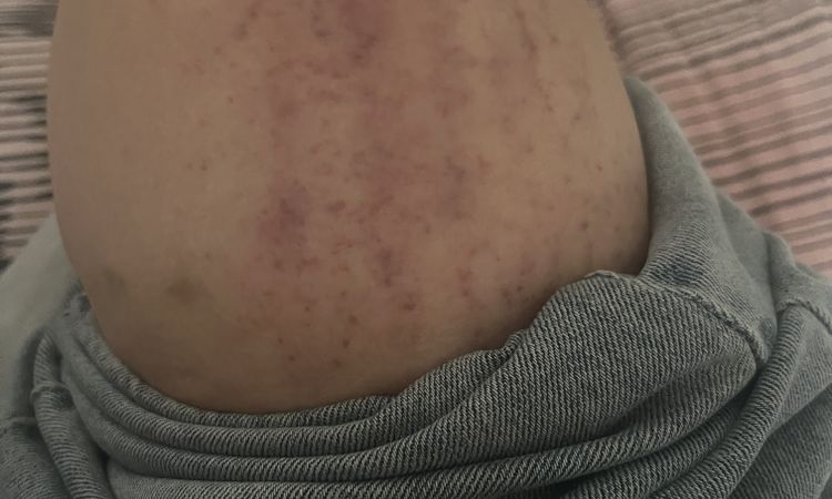 Ematomi strani dopo che mi gratto la gamba - 80706