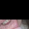 Filler mento e reazione