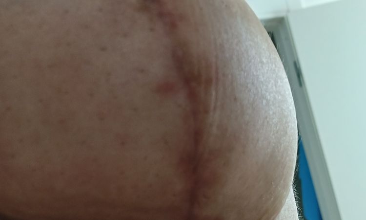 Mastopessi venuta male, posso pretendere un ritocco gratuito? - 80872
