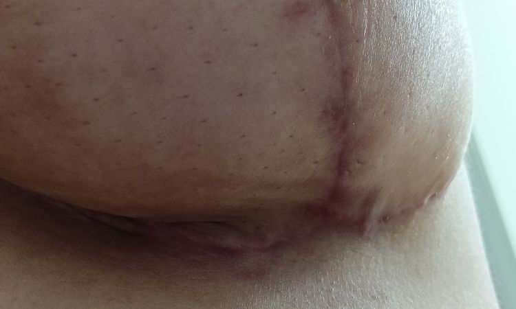Mastopessi venuta male, posso pretendere un ritocco gratuito? - 80875
