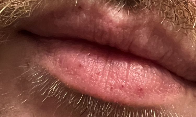Capillari labbra e viso (HHT?) - 80972