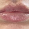Asimmetria post filler