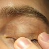 Dermatite sulla palpebra?