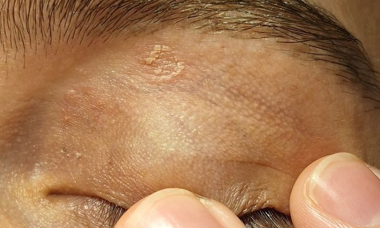 Dermatite sulla palpebra? - 81002