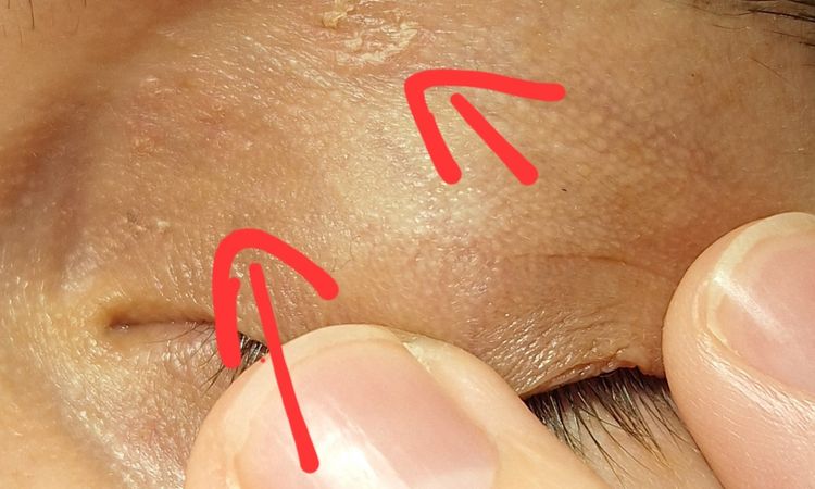 Dermatite sulla palpebra? - 81003