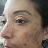 Macchie viso molto profonde dopo il laser con una infiammazione acuta