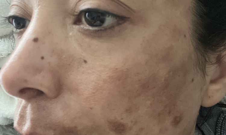 Macchie viso molto profonde dopo il laser con una infiammazione acuta - 81051