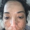 Macchie viso molto profonde dopo il laser con una infiammazione acuta