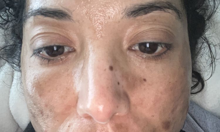 Macchie viso molto profonde dopo il laser con una infiammazione acuta - 81052