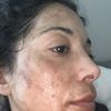 Macchie viso molto profonde dopo il laser con una infiammazione acuta