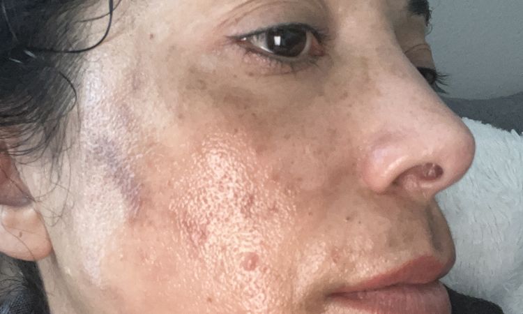 Macchie viso molto profonde dopo il laser con una infiammazione acuta - 81053