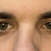 Botox o blefaroplastica su ptosi lieve?