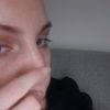 Bozzo duro e dolente post filler nasolabiale