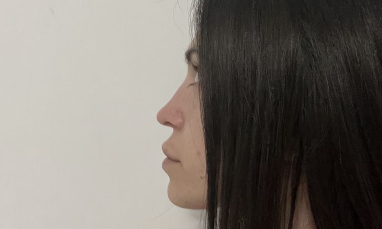 Risultato deludente due mesi post rinoplastica - 81227