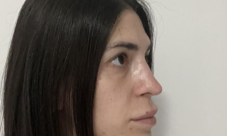 Risultato deludente due mesi post rinoplastica - 81228