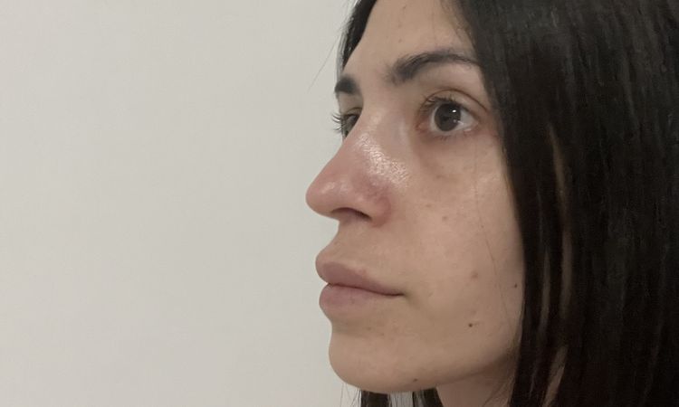 Risultato deludente due mesi post rinoplastica - 81229