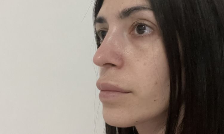 Risultato deludente due mesi post rinoplastica - 81230