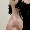 Pallina sul naso dopo rinoplastica terziaria
