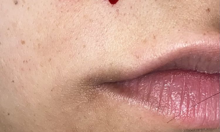 Seduta laser e neo viso - 81416