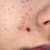 Seduta laser e neo viso