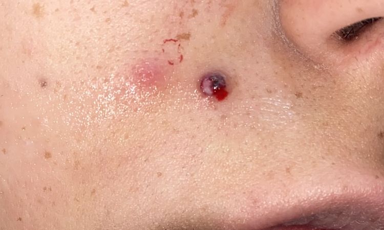 Seduta laser e neo viso - 81417