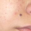 Seduta laser e neo viso